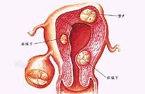 怎么判斷女性患了多囊卵巢綜合癥？