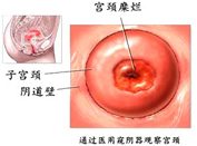 美國莎頓120宮頸修復系統 深度除糜爛不傷宮頸