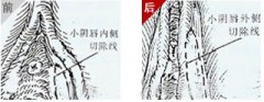 第五代韓式陰唇整形術完美無痕女性新選擇